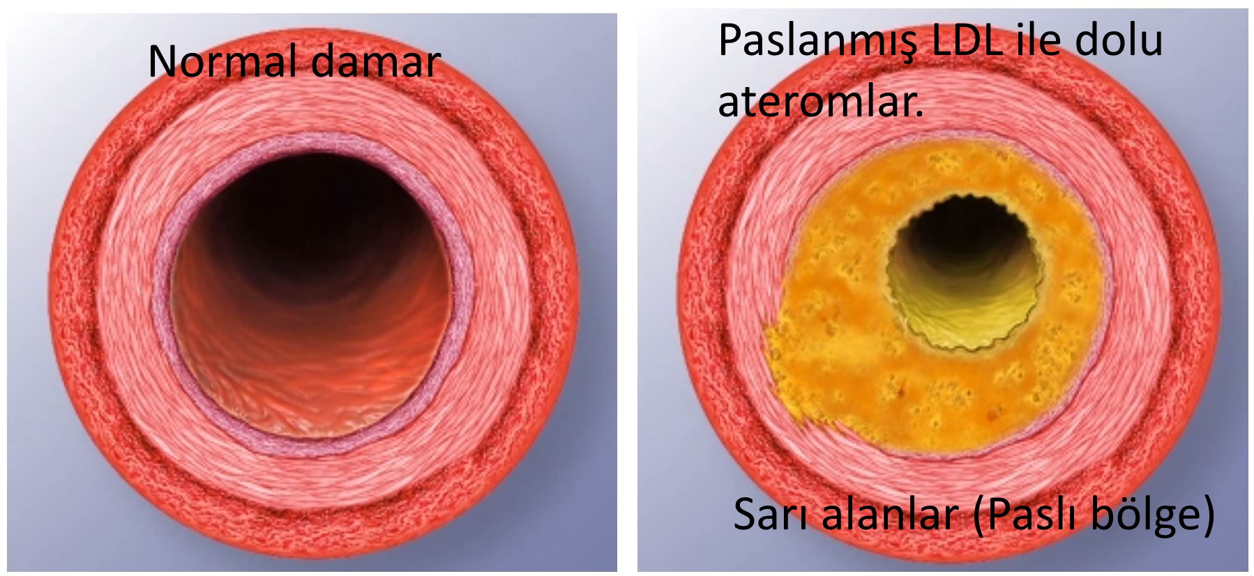 kalplerin uzerinin paslanmasi koroner arter hastaligi kalplerin sertlesmesi ateroskloroz aterom plagi