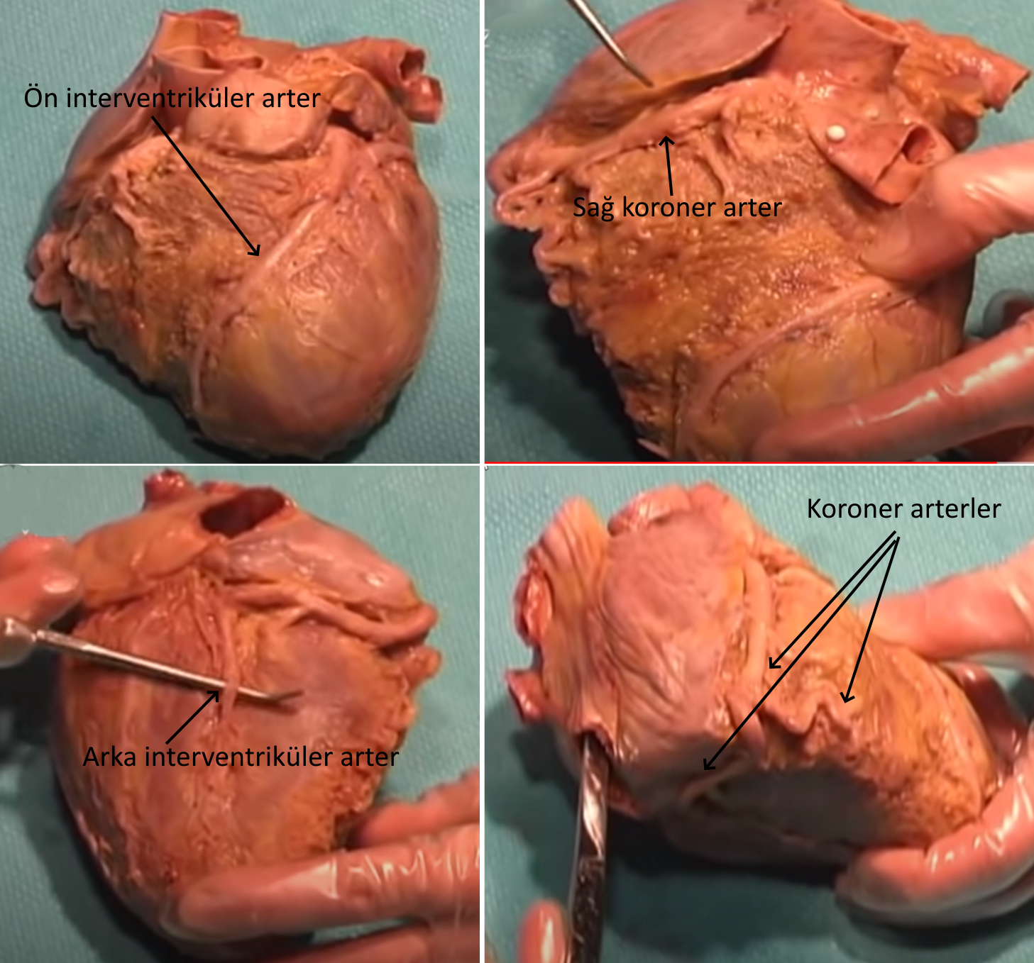 kalplerin uzerinin paslanmasi koroner arter hastaligi kalplerin sertlesmesi gercek insan kalbi