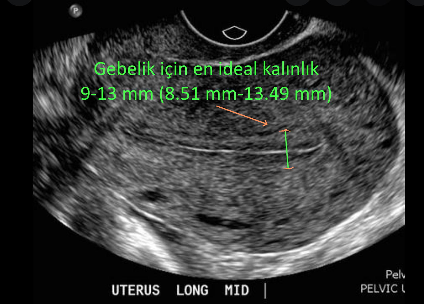 rahim zari endometrium kalinlik