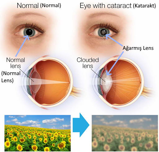 katarakt gozlerin agarmasi 1